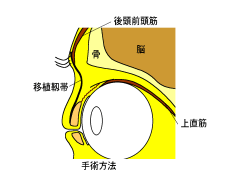 （先天性眼瞼下垂の術後）