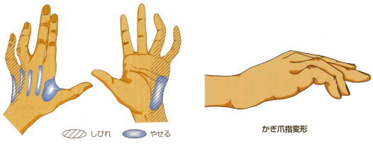 イラスト[日本手の外科学会]転載許可済