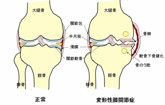 変形性膝関節症について 一般財団法人永頼会 松山市民病院