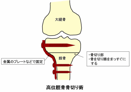 高位脛骨骨切り術