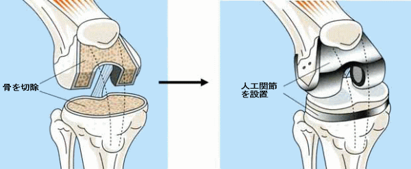 人工膝関節置換術