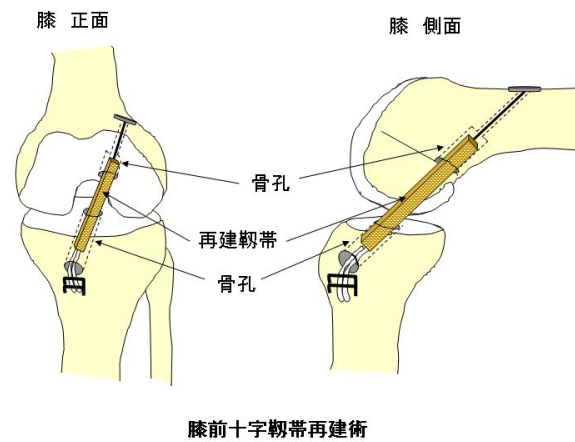 関節鏡視下靱帯再建術